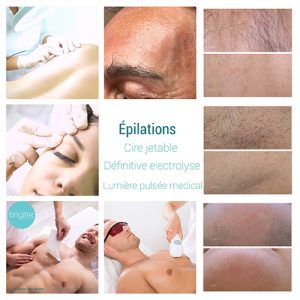Epilation définitive elle et lui