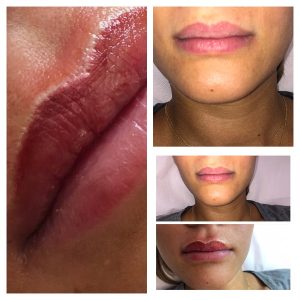 offre arc cupidon Arc de Cupidon kiss Inject